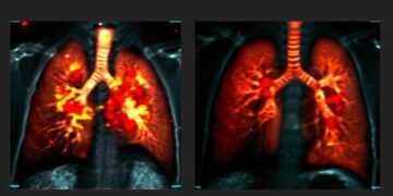 Breathing Breakthrough: Real-Time Lung Scans Transform Treatment