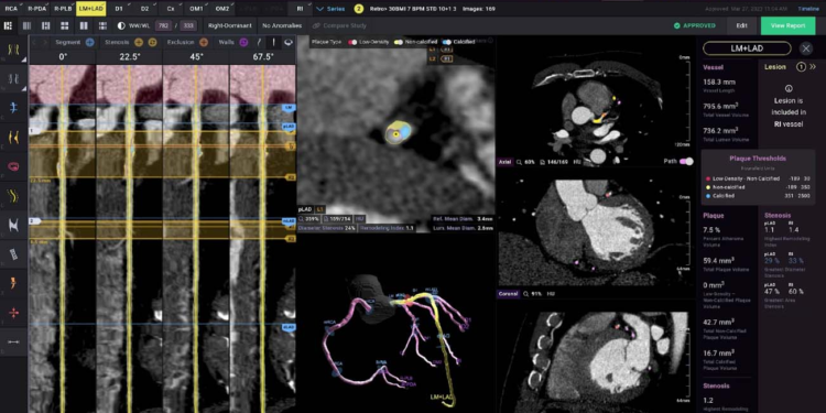 Cleerly Secures $106M to Advance AI-Powered Cardiac Care