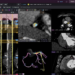 Cleerly Secures $106M to Advance AI-Powered Cardiac Care