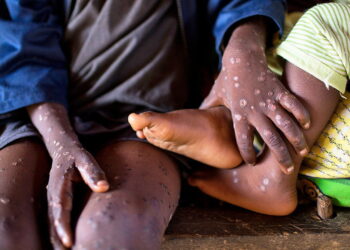 A deadly new strain of mpox is raising alarm