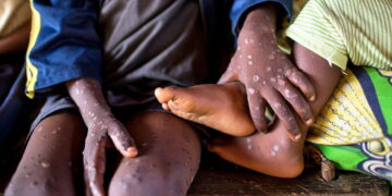 A deadly new strain of mpox is raising alarm