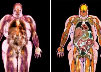 Is obesity a disease?