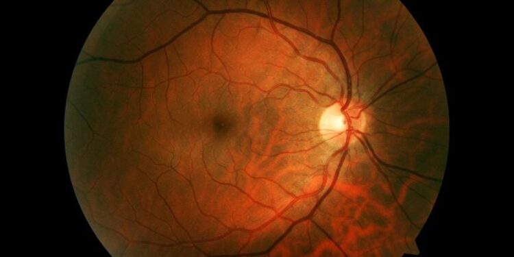This Non-Invasive Eye Scan Could Predict Your Stroke Risk