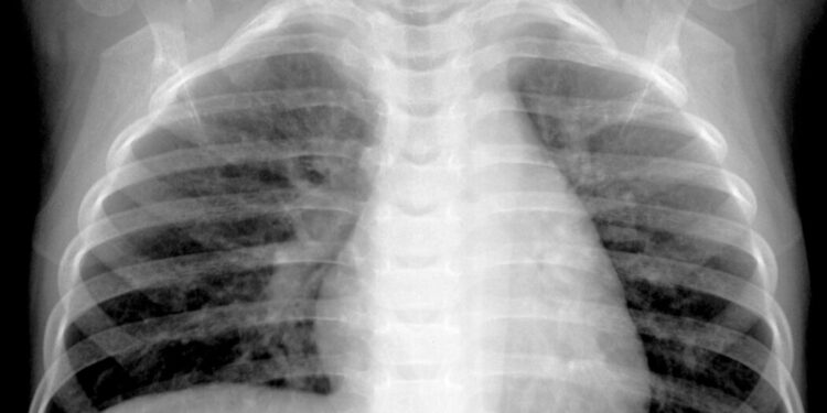 What We Know About HMPV, the Virus Spreading in China