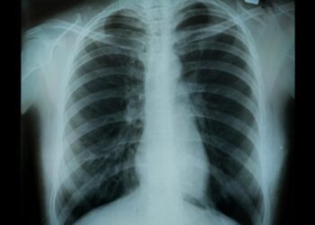 Dangerously Underdiagnosed: The Silent Killer Affecting 30 Million Americans and Counting