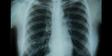 Dangerously Underdiagnosed: The Silent Killer Affecting 30 Million Americans and Counting