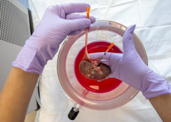 This Kidney Was Frozen for 10 Days. Could Surgeons Transplant It?