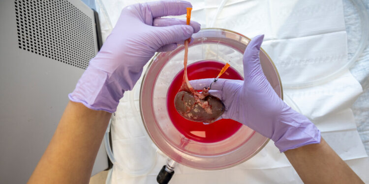 This Kidney Was Frozen for 10 Days. Could Surgeons Transplant It?