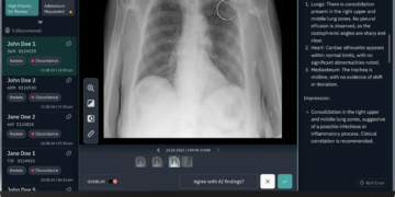 University Hospitals Cleveland Taps AI For Early Lung Cancer Detection –