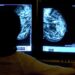 ‘Transformational’ new drug could stop breast cancer tumours before they grow, trial finds | Science, Climate & Tech News