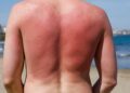 Sunburn isn’t just red skin – here’s what’s happening underneath the burn | Science, Climate & Tech News