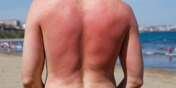 Sunburn isn’t just red skin – here’s what’s happening underneath the burn | Science, Climate & Tech News