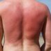 Sunburn isn’t just red skin – here’s what’s happening underneath the burn | Science, Climate & Tech News