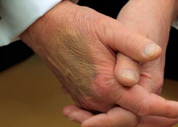 White House Says Trump’s Bruises Stem From ‘Benign And Common Condition’