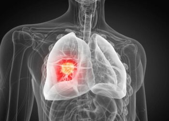 AI Detects Hidden Lung Tumors Doctors Miss — And It’s Fast