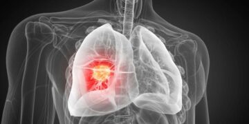 AI Detects Hidden Lung Tumors Doctors Miss — And It’s Fast