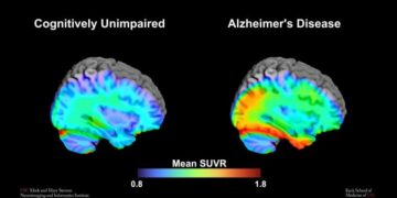 This Tau Brain Scan Could Predict Alzheimer’s Early