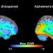 This Tau Brain Scan Could Predict Alzheimer’s Early