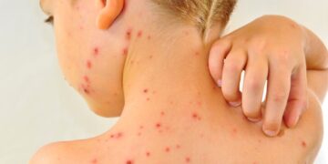 Chickenpox vaccine to be offered on NHS next year, as part of routine MMR jab for babies | Science, Climate & Tech News