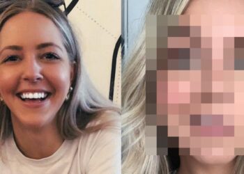 I Had Facial Paralysis, So I Had Smile Surgery