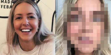 I Had Facial Paralysis, So I Had Smile Surgery