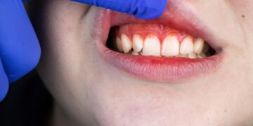Natural Plant Compound Shows Promise for Treating Gum Disease