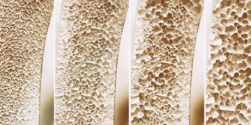 The Newly Found Bone Switch That Could Stop Osteoporosis