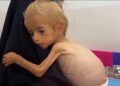 Toddler evacuated from Gaza recovers from malnutrition in Italian hospital