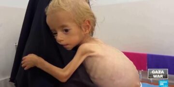 Toddler evacuated from Gaza recovers from malnutrition in Italian hospital