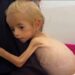 Toddler evacuated from Gaza recovers from malnutrition in Italian hospital