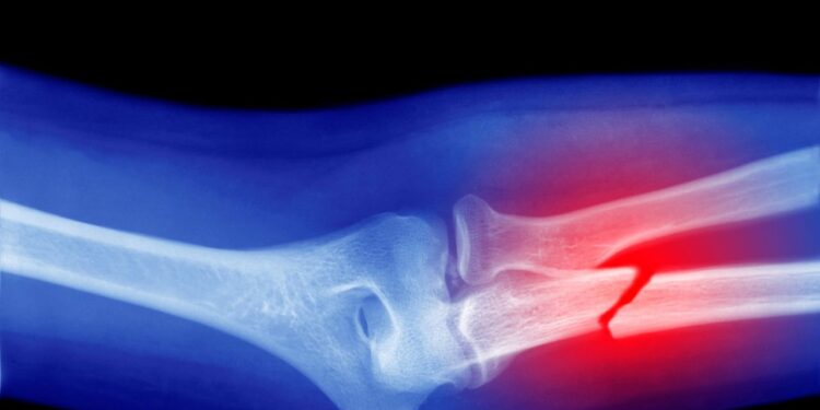 Microplastics Could Be Weakening Your Bones, Research Suggests