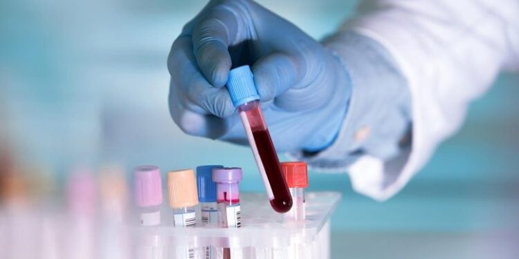 Breakthrough Blood Test Detects Head and Neck Cancer up to 10 Years Before Symptoms
