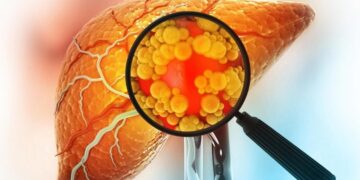 Mayo Clinic Discovers Genetic Twist That Rewrites Rules on Common Liver Disease