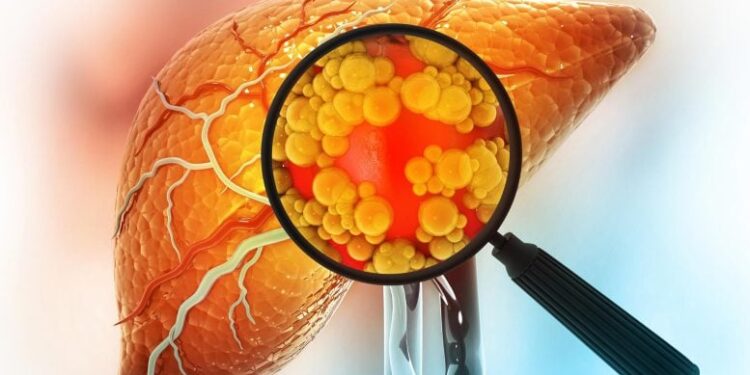 Mayo Clinic Discovers Genetic Twist That Rewrites Rules on Common Liver Disease