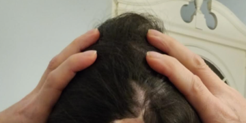 The Link Between My Cancer Surgery & Years Of Neck Pain