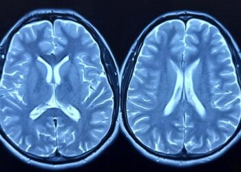 Largest Study of African American Brain Tissue Unveils Critical Alzheimer’s Gene