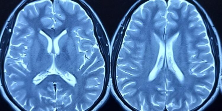 Largest Study of African American Brain Tissue Unveils Critical Alzheimer’s Gene