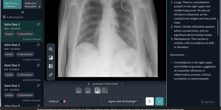 How Horizon Health and Qure.ai Are Using AI to Catch “Incidental” Lung Cancer