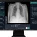 How Horizon Health and Qure.ai Are Using AI to Catch “Incidental” Lung Cancer