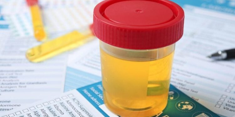Simple Urine Test Could Revolutionize Bladder Cancer Diagnosis and Treatment