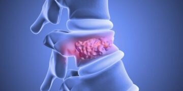 Fat Stem Cells Heal Broken Spines in a Breakthrough Study