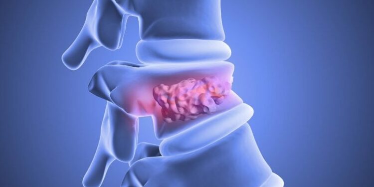 Fat Stem Cells Heal Broken Spines in a Breakthrough Study