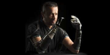 Amputees often feel disconnected from their bionic hands. AI could bridge the gap : Shots