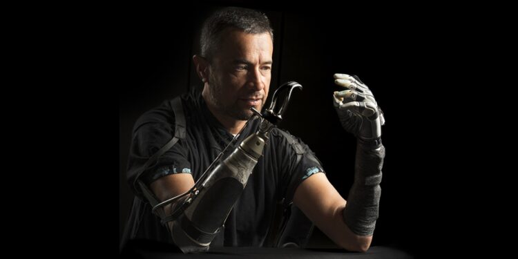 Amputees often feel disconnected from their bionic hands. AI could bridge the gap : Shots