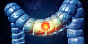 Alcohol’s Hidden Cancer Risk Builds Over Time