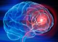 Scientists Develop IV Therapy That Repairs the Brain After Stroke