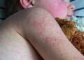 UK loses measles elimination status, warns WHO | UK News