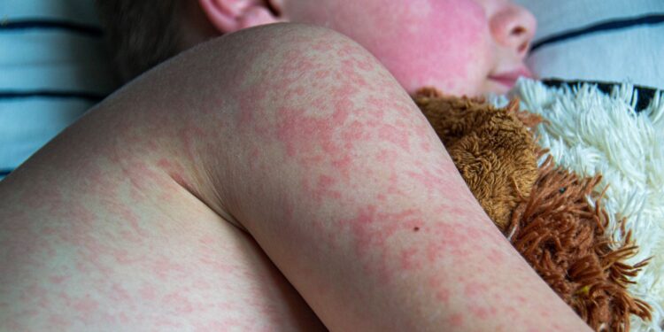 UK loses measles elimination status, warns WHO | UK News