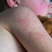 UK loses measles elimination status, warns WHO | UK News