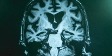 Beyond Amyloid Plaques: Scientists Reveal Broader Chemical Disruptions in Alzheimer’s